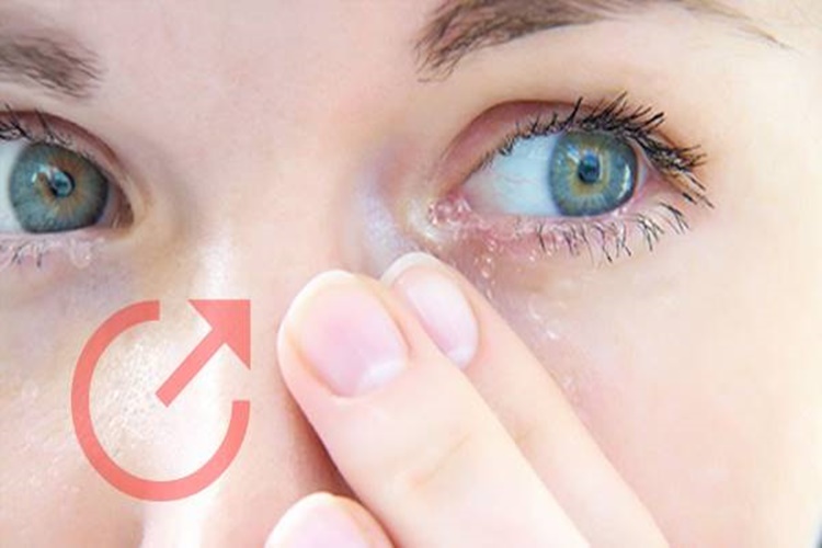 Bebeklerde Gözyaşı Kanalı Tıkanıklığı Nedir?