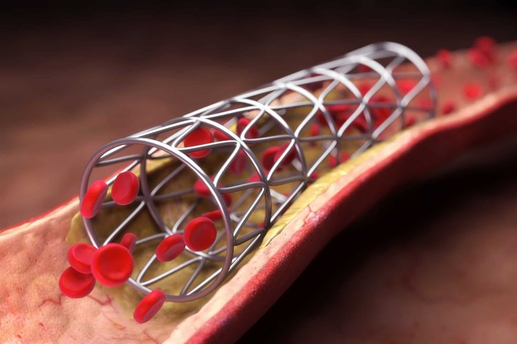 Beyne Stent Takıldıktan Sonra Ağır Yük Kaldırılır Mı?