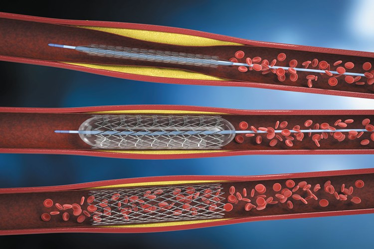 Beyne Stent Takıldıktan Sonra Ağrı Nasıl Geçer?