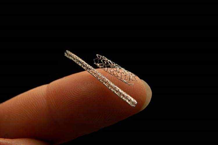 Beyne Stent Takıldıktan Sonra Ağrı Olur Mu?