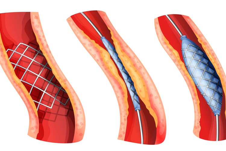 Beyne Stent Takıldıktan Sonra Çarpıntı Nasıl Geçer?