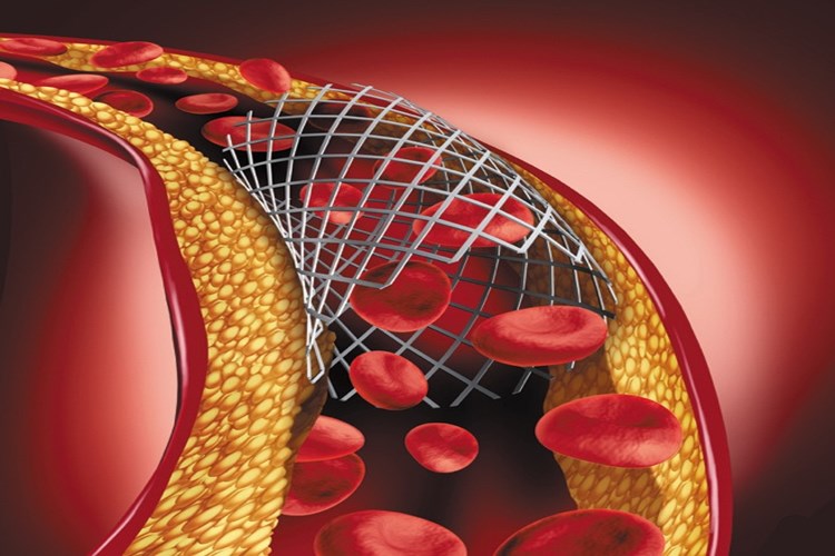 Beyne Stent Takıldıktan Sonra Çarpıntı Olur Mu?