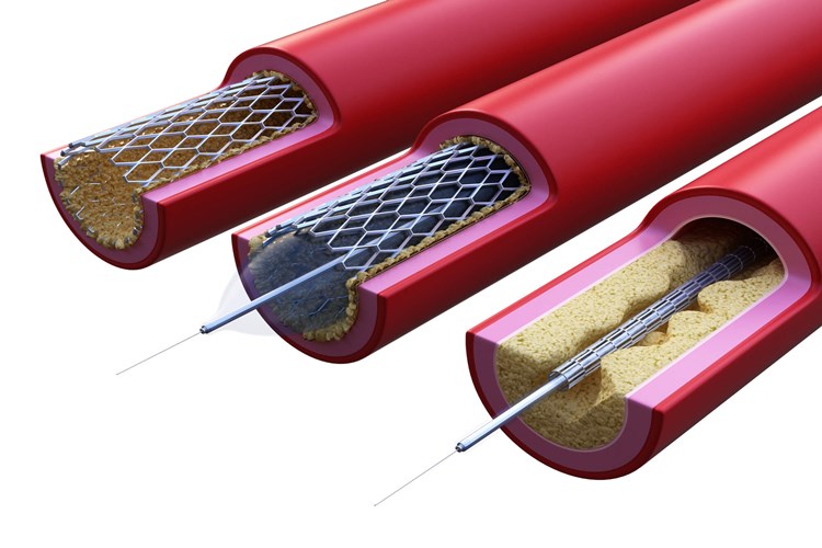 Beyne Stent Takıldıktan Sonra Tansiyon Düşüklüğü Nasıl Geçer?
