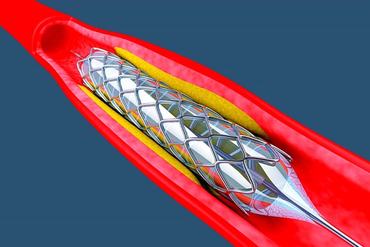 Beyne Stent Takıldıktan Sonra Yenilmemesi Gerekenler Nelerdir?