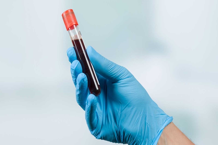 Candida Testi Evde Nasıl Yapılır?
