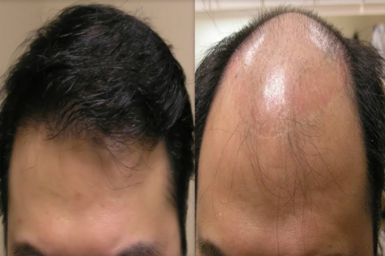 Bioxcin Serum Saç Çıkarır Mı?