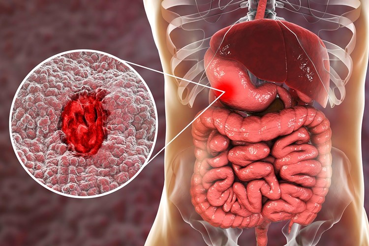 Bisküvi Ülsere İyi Gelir Mi?