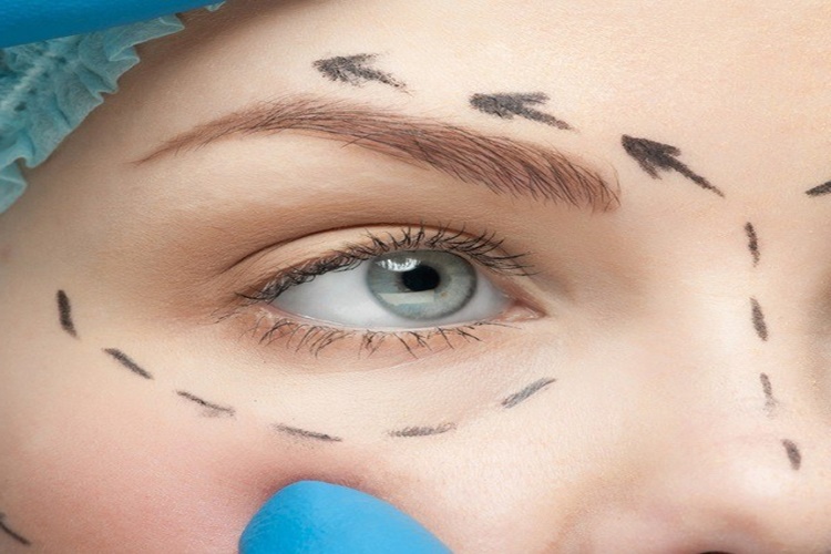 Blefaroplasti Ameliyatı Nedir?