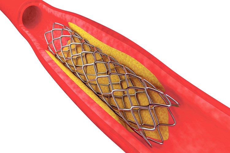 Böbreğe Stent Nasıl Takılır?