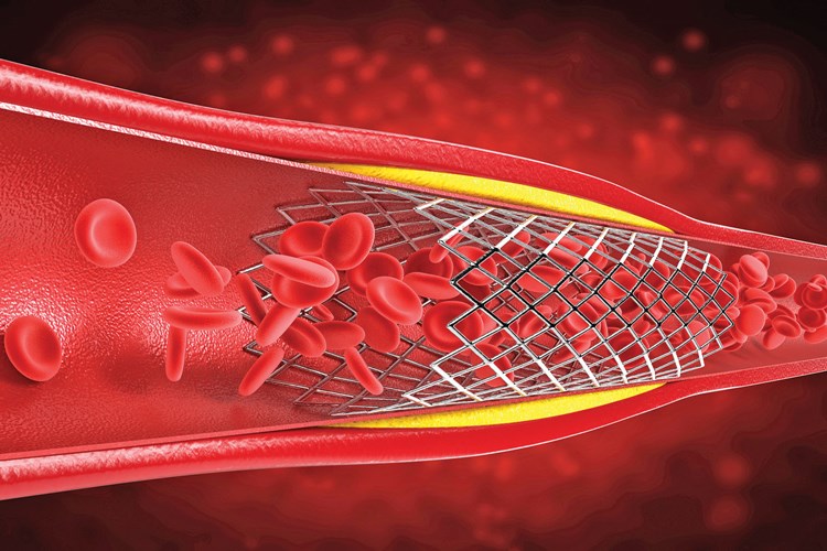 Böbreğe Stent Nerden Takılır?