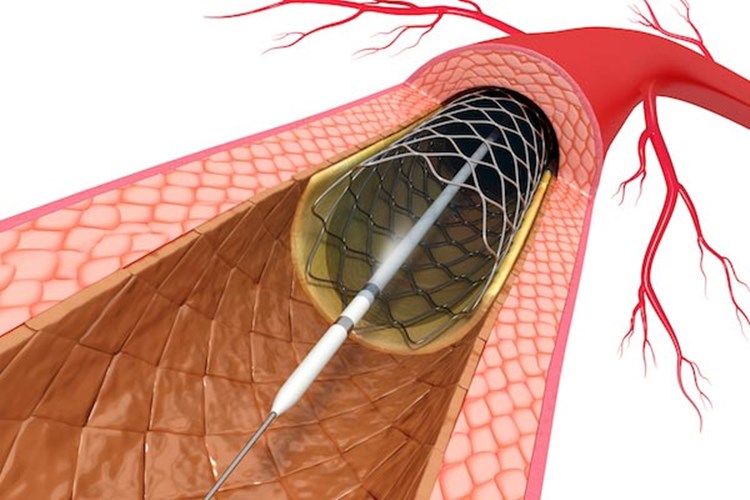 Böbreğe Stent Takıldıktan Sonra Ağrı Nasıl Geçer?