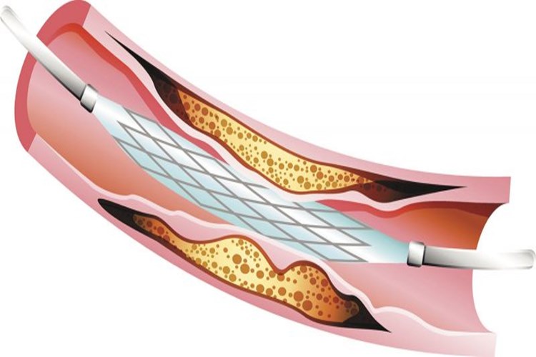 Böbreğe Stent Takıldıktan Sonra Ağrı Neden Olur?