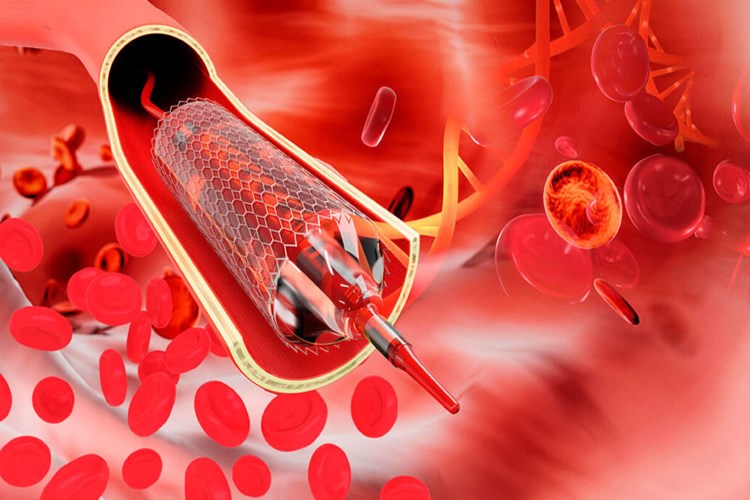 Böbreğe Stent Takıldıktan Sonra Alkol İçilir Mi?