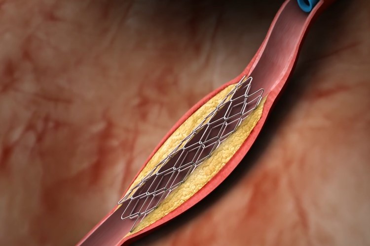Böbreğe Stent Takıldıktan Sonra Kanama Neden Olur?