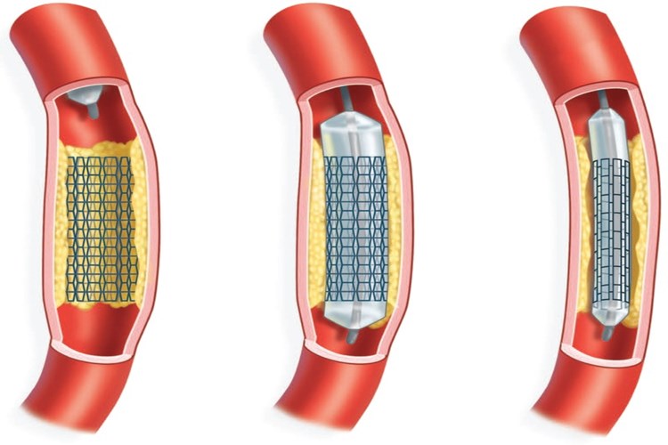 Böbreğe Stent Takıldıktan Sonra Kanama Olur Mu?