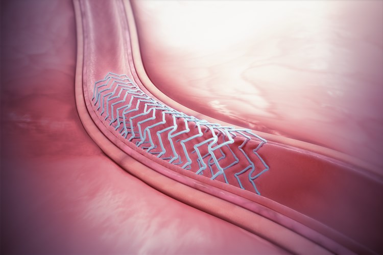 Böbreğe Stent Takıldıktan Sonra Taburcu Olma Süresi Ne Kadardır?