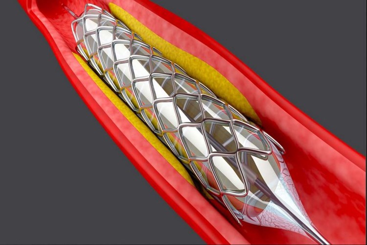 Böbreğe Stent Takılması Ne Kadar Sürer?