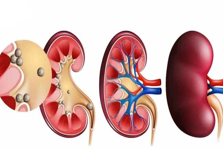 Böbrek Taşı İçin Hangi Doktora Gidilir?