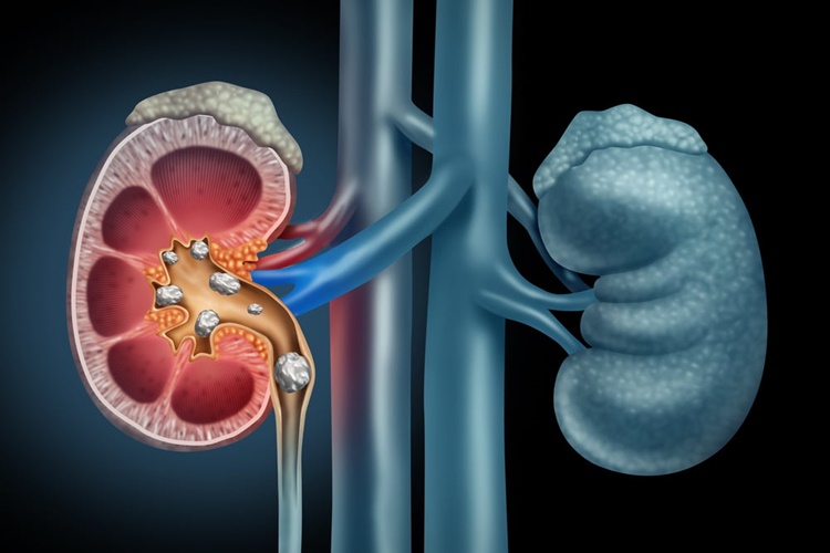 Böbrek Taşı İle İlgili Merak Edilenler Nelerdir?