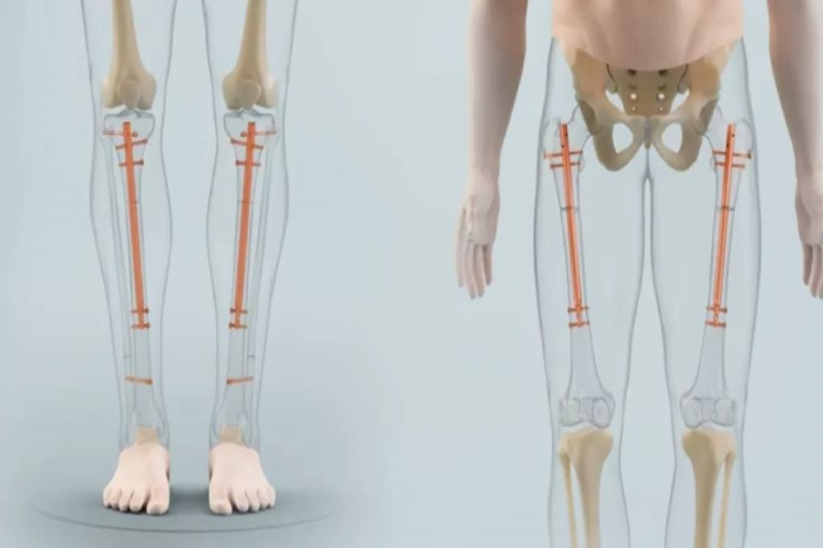 Boy Uzatma Ameliyatı Polisliğe Engel Mi?