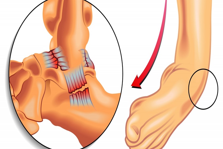 Burkulmalarda İlk Yardım Nasıl Yapılır?