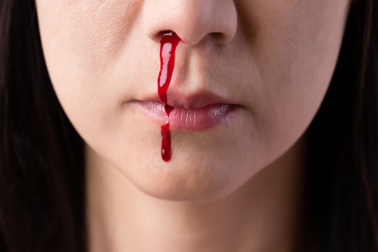 Burun Kanaması Hakkında Merak Edilenler