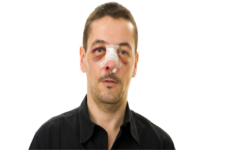 Burun Kırılması Nasıl Anlaşılır?
