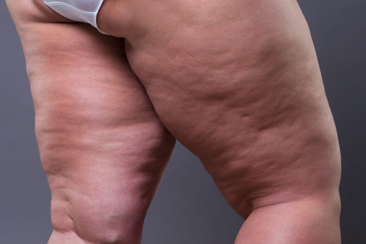 C Vitamini Ödem Yapar Mı?
