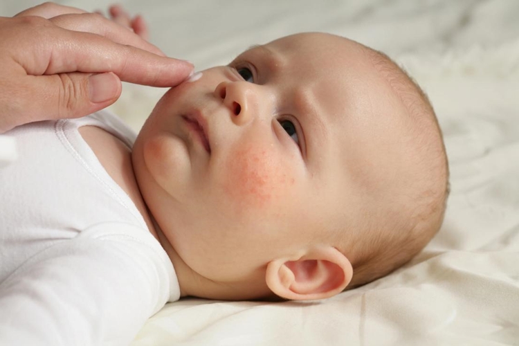 Calpol Alerji Yapar Mı?
