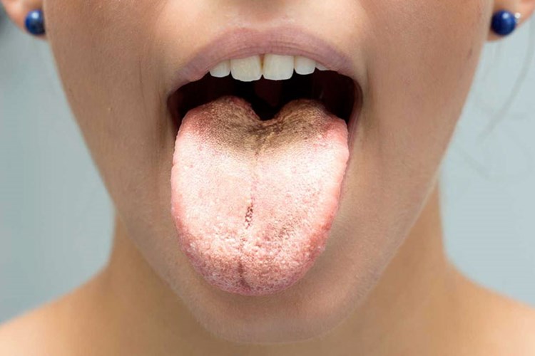 Candida Albicans Neden Olur?