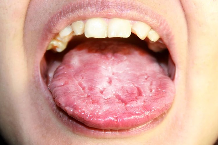 Candida Auris Nasıl Bulaşır?