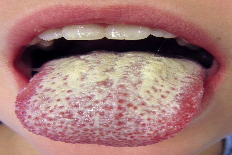 Candida Belirtileri Nelerdir?