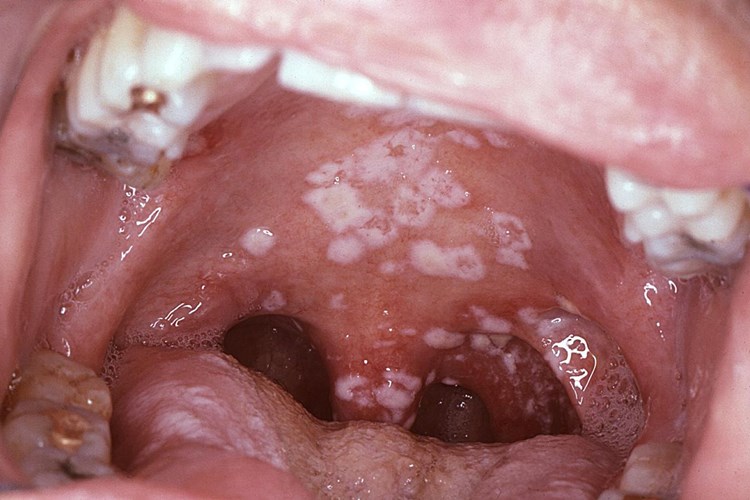 Candida Enfeksiyonu Belirtileri Nelerdir?