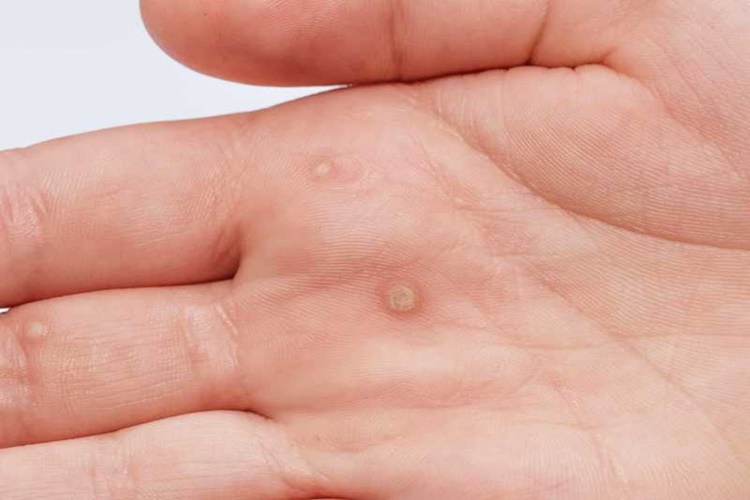 Candida Siğil Yapar Mı?
