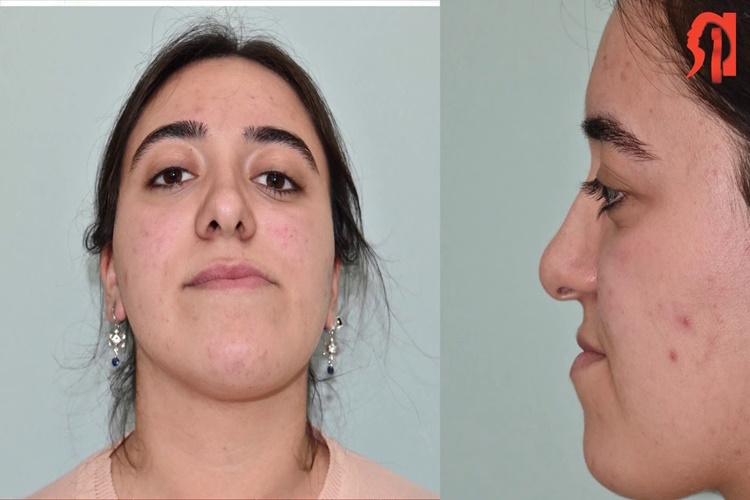 Çene Estetiği Çeşitleri Nelerdir?