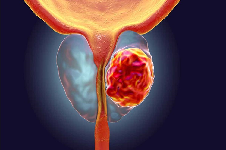 Cialis 5 Mg Prostata İyi Gelir Mi?