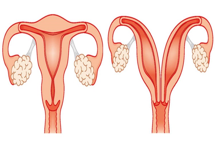 Çift Rahim Sonradan Olur Mu?