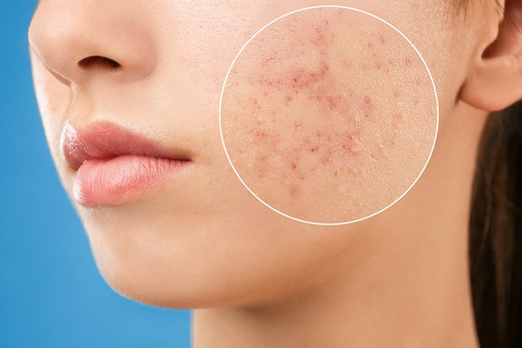 Çıkmak Üzere Olan Sivilce Nasıl Söndürülür?