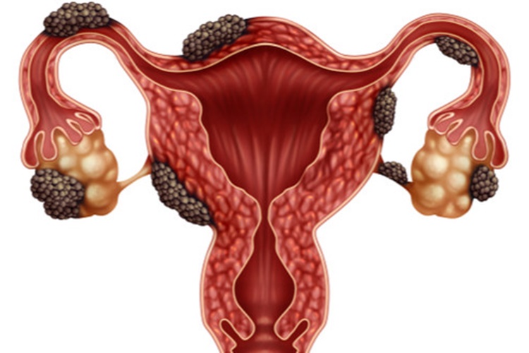 Çikolata Kisti Tedavisi Nasıl Yapılır?