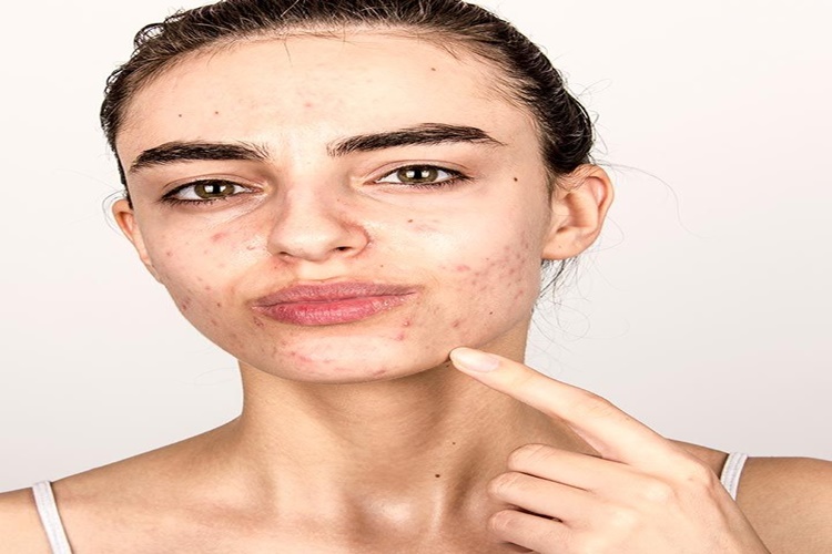 Cilt Bariyeri Onarıcı Doğal Yöntemler Nelerdir?