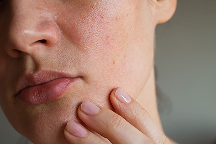 Cilt Kuruluğu Maskesi Nasıl Yapılır?