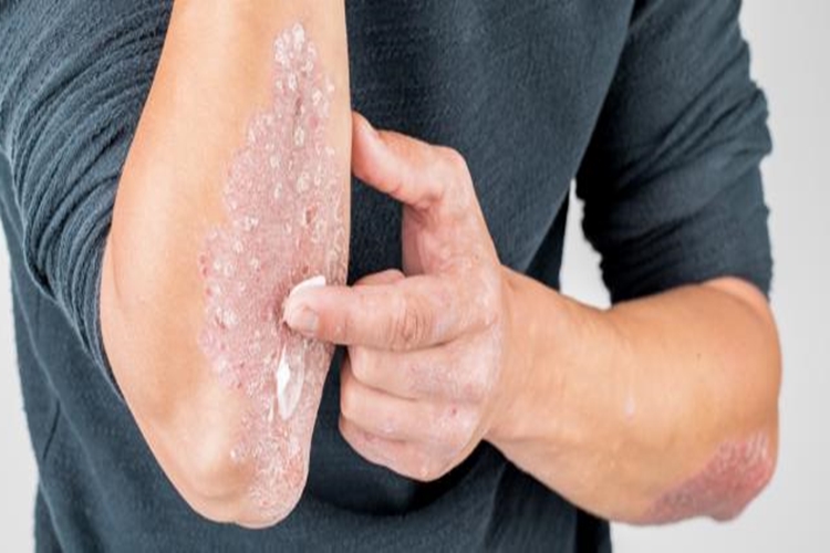 Cilt Mantarına Hangi Krem İyi Gelir?