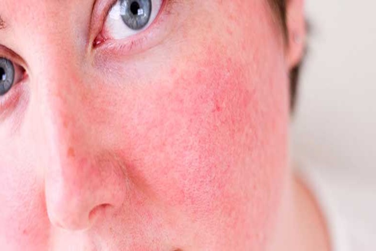 Ciltte Yanma Hissi Neden Olur?