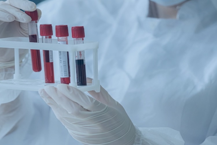  Cinsel Yolla Bulaşan Hastalıklar Testi Ne Zaman Yapılmalı?