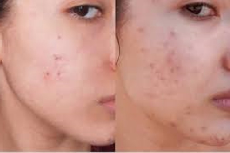 Clindoxyl Jel Yüzde Kaç Saat Kalmalı?