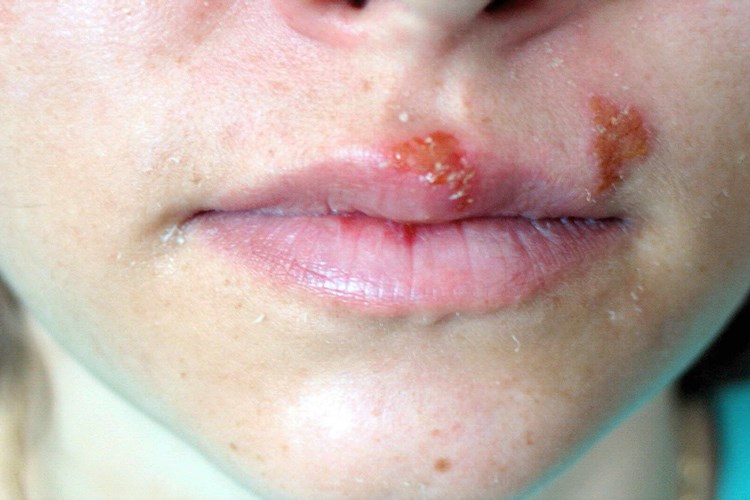 Clindoxyl Uçuk İçin Kullanılır Mı?
