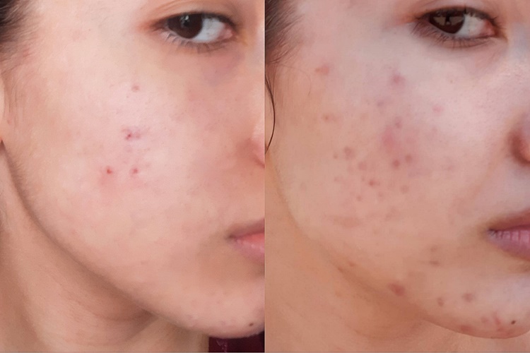  Clindoxyl Yüzde Kaç Saat Kalmalı?