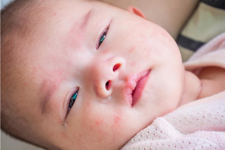 Çocuğun Yüzü Neden Kızarır?