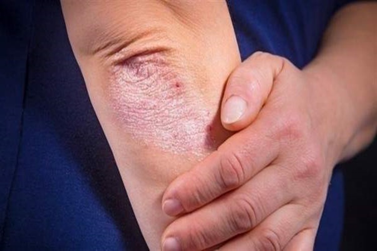 Çölyak Hastalığı Kaşıntı Yapar Mı?