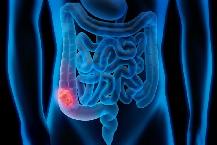 Çölyak Vitamin Eksikliğinden Olur Mu?